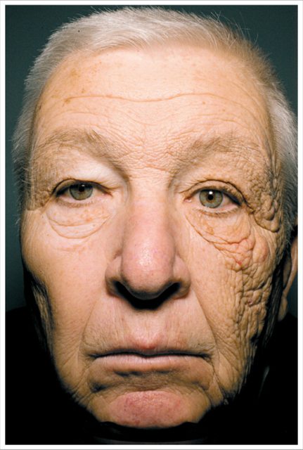 UV and Skin Damage